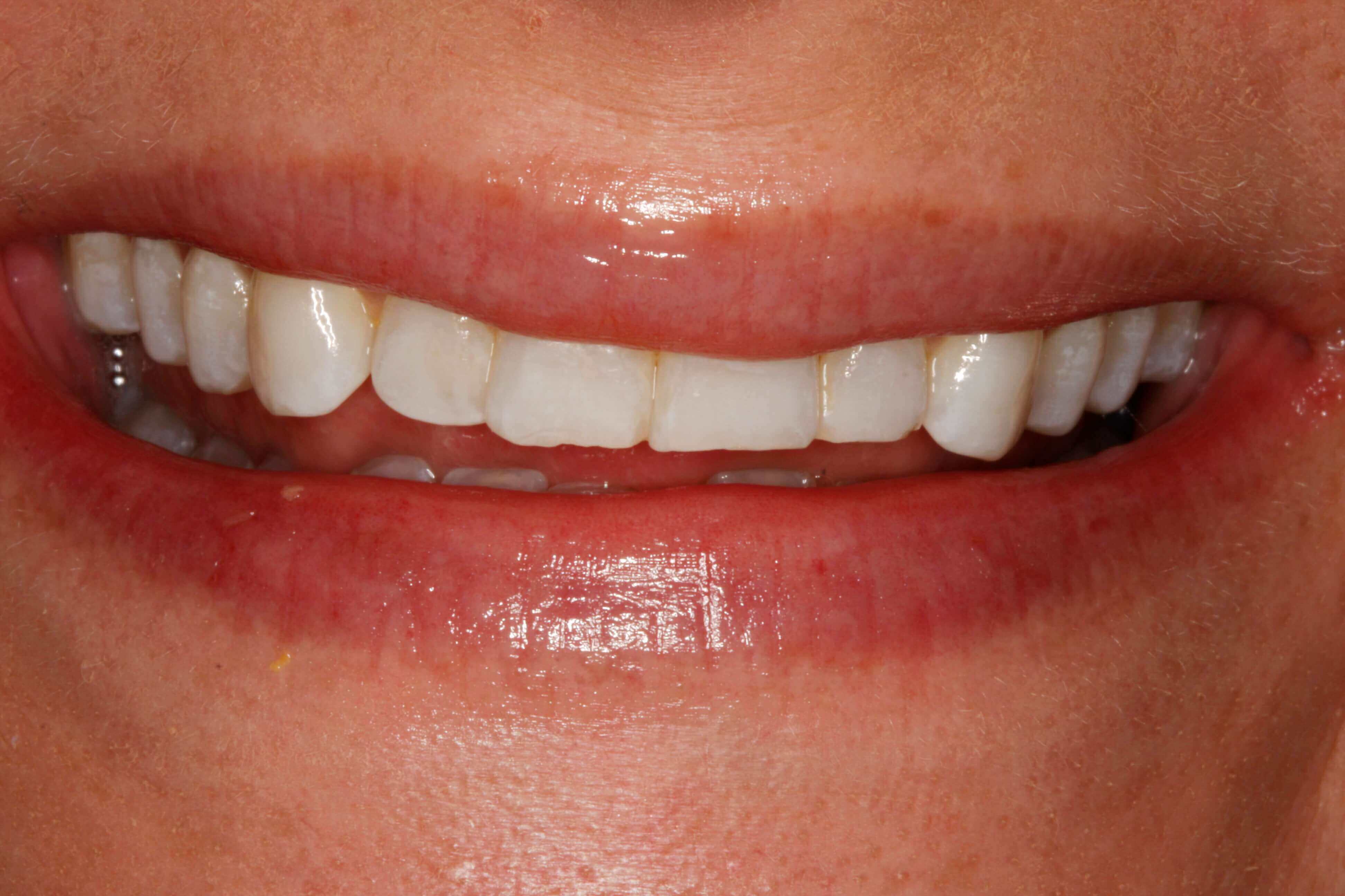 Image of teeth before treatment